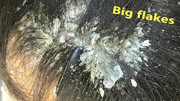 Big flakes || Dandruff Scratching Scalp || Itchy Dry Scalp Treatment #514