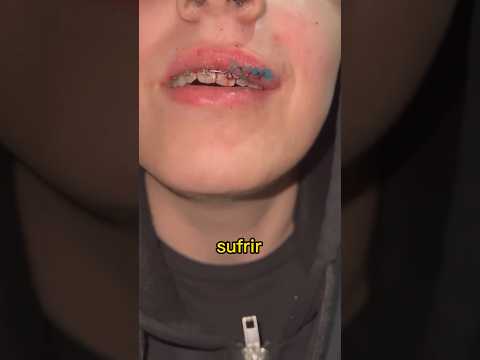 Los brackets pueden salvar tus dientes si tienes un golpe tan BRUTAL en la boca como este