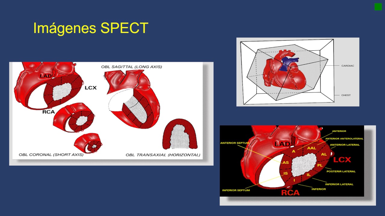 Medicina Nuclear 2017 Dra Traverso SPECT 1 Cardiologìa Nuclear 1