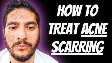 How To Treat Acne Scarring (2025)