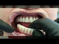 Eskişehir İmplant - Eskişehir İmplant Destekli Protezler | Diş Hekimi Doç. Dr. Emre ŞEKER