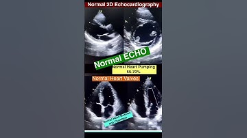 Normal 2D Echocardiogram #echo #shorts