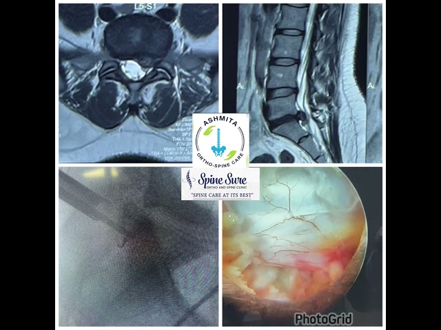 L5S1 Endoscopic Spine Surgery 86 #sciatica #backpain #hyderabad #endoscopicspinesurgery #discproblem
