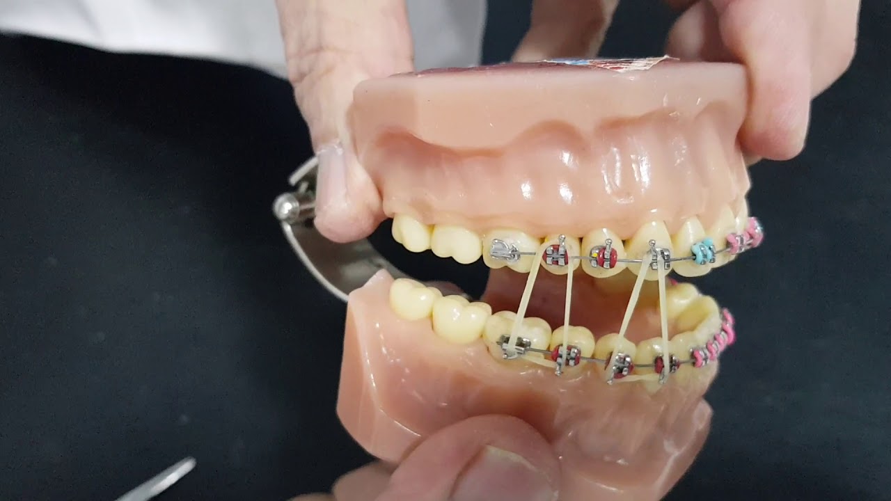 class one elassticsسحب الاسنان بشكل عمودي بتقويم الاسنان