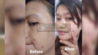 TABITA SKINCARE TESTIMONI