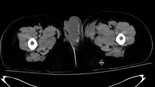 Extraperitoneal bladder rupture