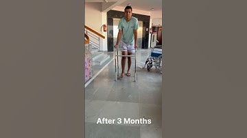 Road Accident 17 feb 2025 proxymal Tibia fracture and 2 stage surgery