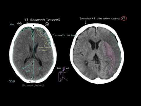 Bilgisayarlı Tomografi, MR ve Anjiyografi İle İnme Teşhisi (Fen Bilimleri) (Sağlık ve Tıp)