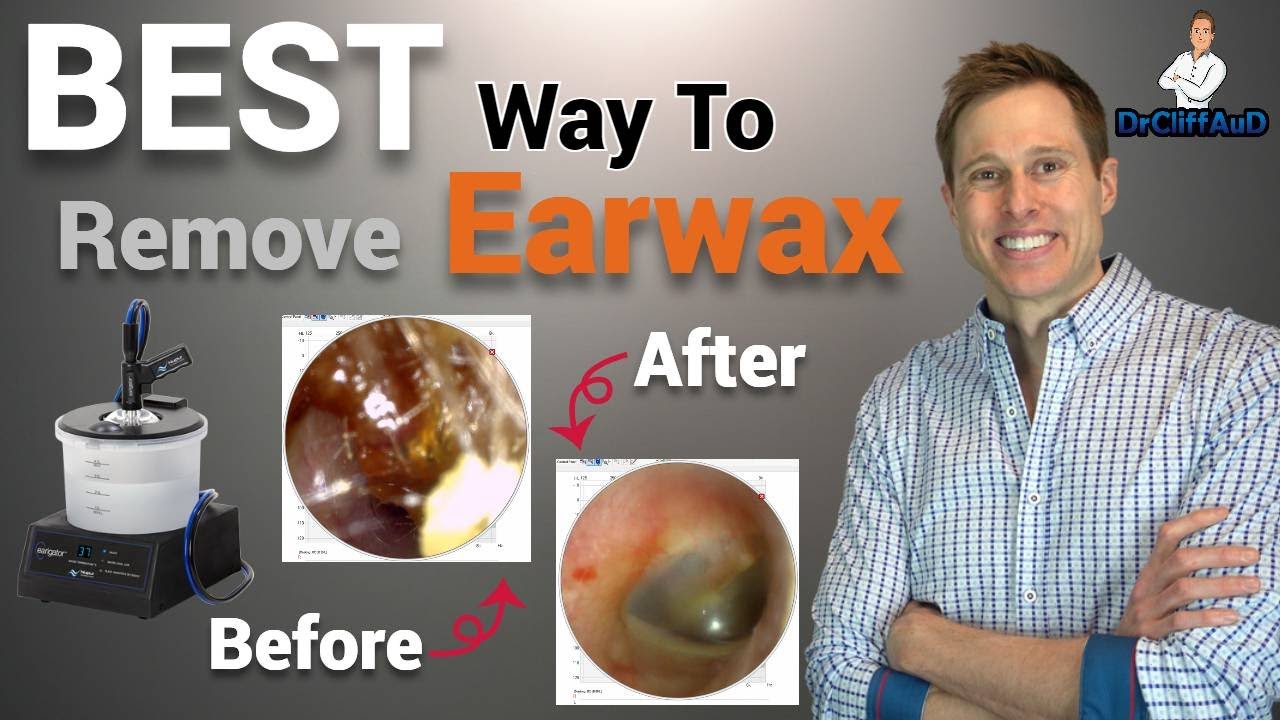 The BEST Way to Professionally Remove Earwax