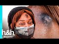 Bulto en su frente creció y se tornó oscuro | Dra. Sandra Lee: Especialista en piel | Discovery H&H