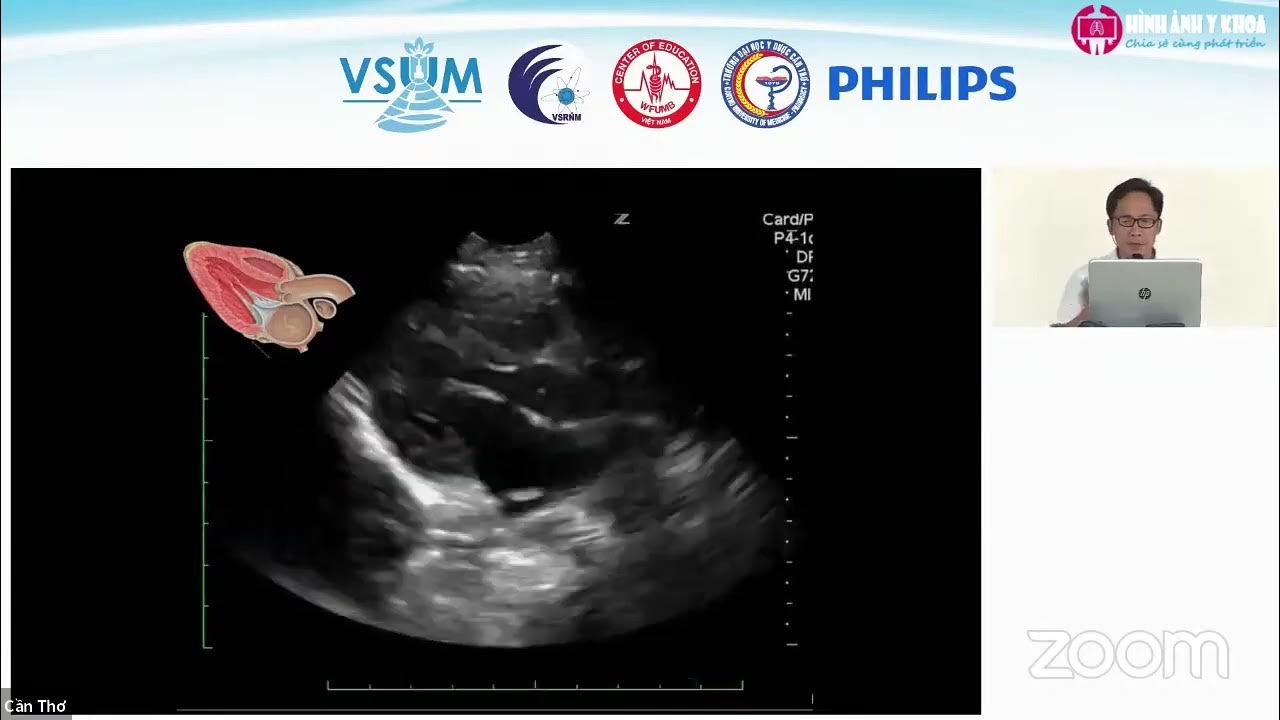 CME 2022] 10 Siêu âm nhanh trong shock và hạ huyết áp (RUSH) - ThS ...