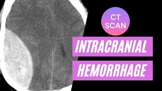 CT imaging of intracranial hemorrhage: For medical students, residents and clinicians.