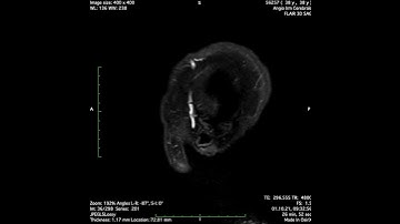 Founder MRI brain scan in real time