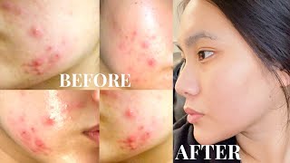 AFFORDABLE  SKINCARE ROUTINE (how I cleared my oily acne skin) | ShilaBui