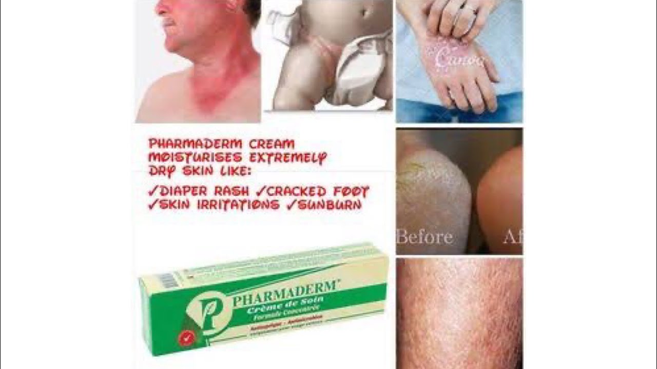 How to clear and prevent white patches| anti reaction cream to add to ur lotion| pharmaderm review