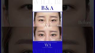WILLBE 눈재수술 B&amp;A🍀 #윌비성형외과 #김준영원장 #willbe #신사역성형외과 #눈성형잘하는곳 #눈성형전후 #눈성형후기 #눈재수술잘하는곳 #눈재수술후기 #쌍꺼풀재수술