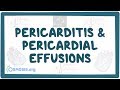 Pericarditis and pericardial effusions - causes, symptoms, diagnosis, treatment, pathology