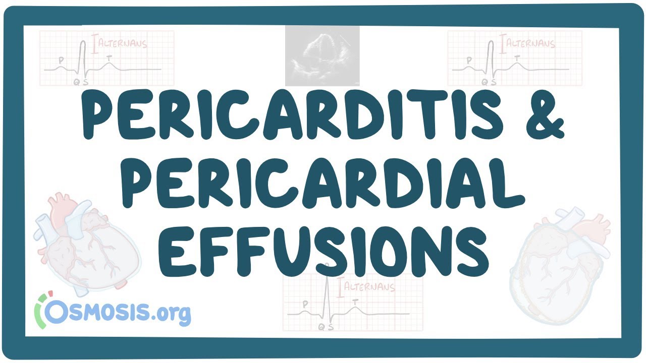 Pericarditis And Pericardial Effusions - Causes, Symptoms, Diagnosis, Treatment, Pathology