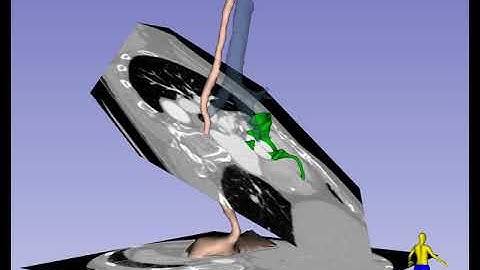Mid-Esophageal Right Ventricle Inflow-Outflow Imaging Plane in TEE - Standard View