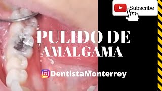 AMALGAMA Dental 👅 PULIDO