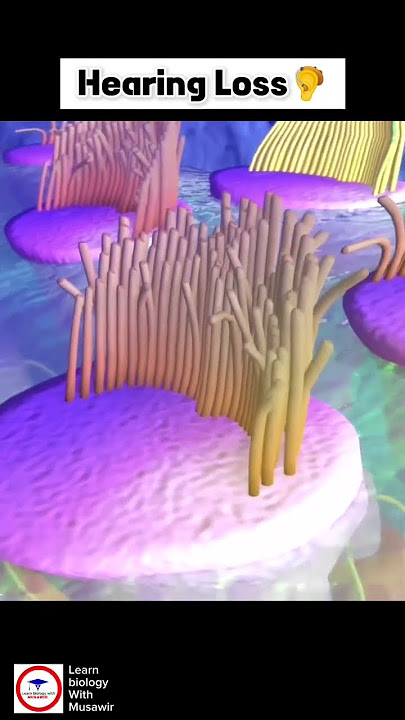 Understanding hearing loss ? #audiology #dhvanihearingclinic #hyderabad #earcare  #tinnitus