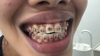 How Dental Braces Are Applied on Teeth - ការពត់ធ្មេញ #shorts #ពត់ធ្មេញ #dentist