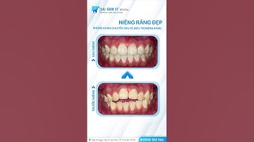 ✨ Hành trình thay đổi nụ cười nhờ niềng răng tại Nha Khoa Sài Gòn ST