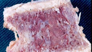 Paget's Disease Of Bone - Pathology Mini Tutorial Paget's Disease Of Bone - Pathology Mini Tutorial