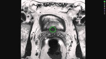 Automatic Prostate Segmentation