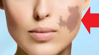 how to get rid of birthmarks on your face naturally at home