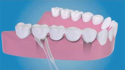 Dental Floss for Bridges and Dental Implants, 5 Packs - Floss Threaders for Bridges and Impl Reviews