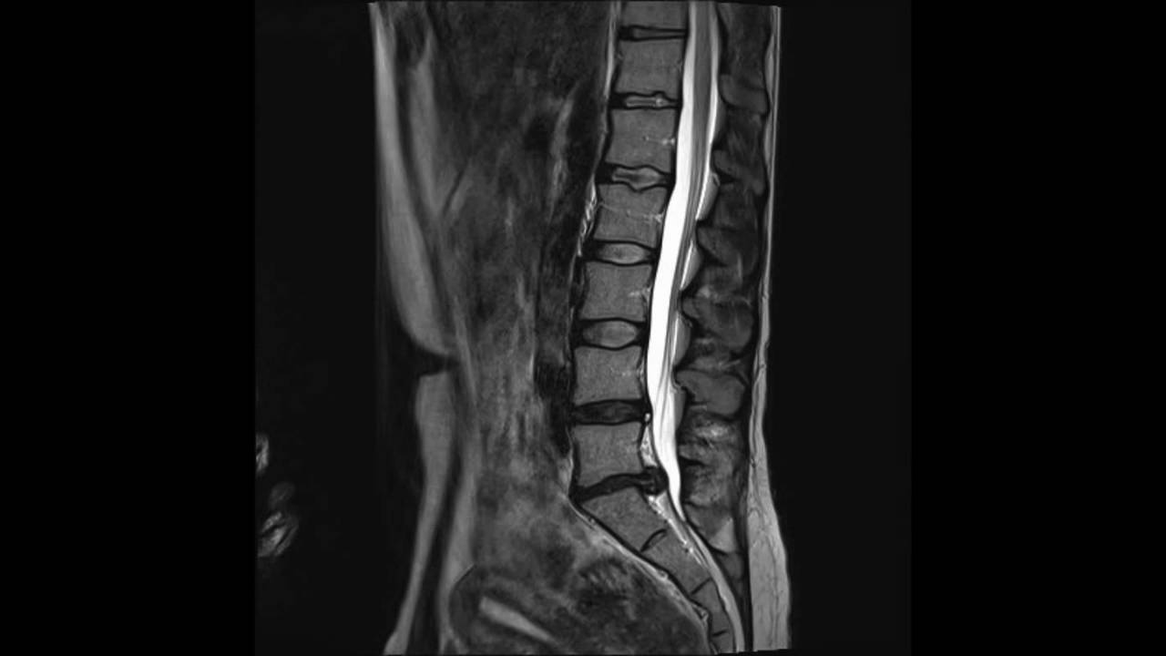 L4 l5 herniated disc