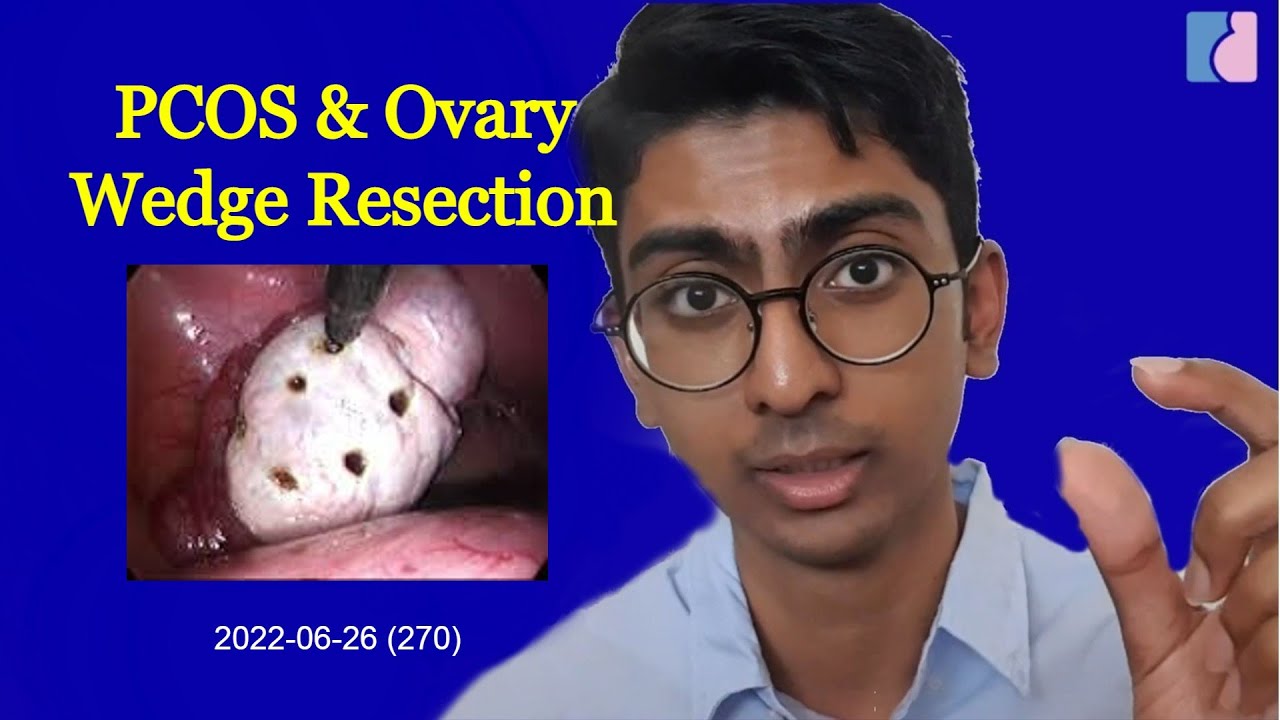 PCOS Ovarian Wedge Resection Antai Hospitals YouTube PCOS Ovarian Wedge Resection Antai Hospitals YouTube