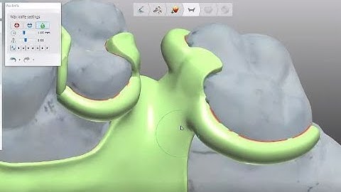 3Shape CAD training for smaller saddles on your RPD-#4