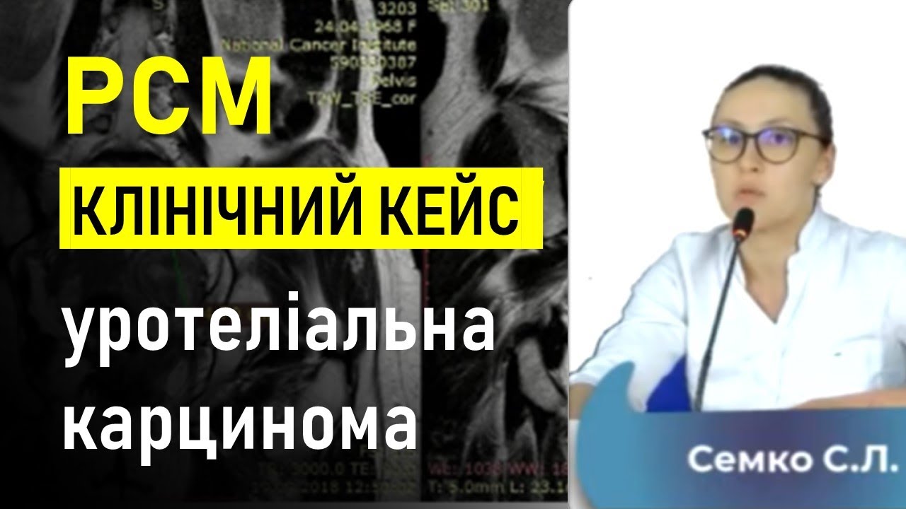 РСМ: КЛІНІЧНИЙ ВИПАДОК уротеліальна карцинома (Семко С.Л., Національний інститут раку)
