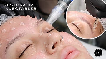 EXOSOME SKIN REJUVENATION | Microneedling with Exosomes | Regenerative Therapy