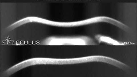 All you have ever wanted to see and measure about Corneal Biomechanics.mpg