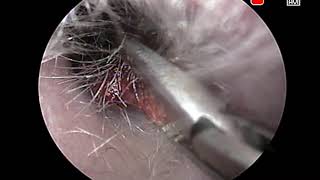 Удаление серной пробки. Ear wax removal