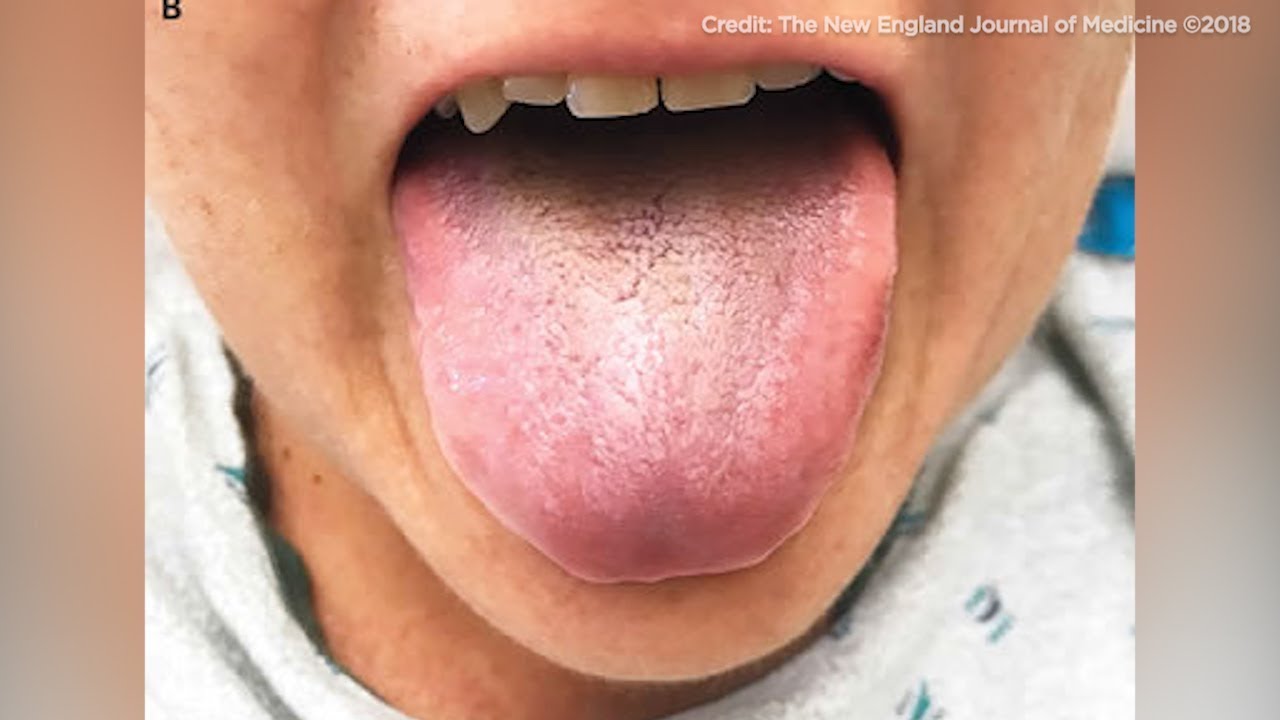 Patient treated with antibiotics develops 'black hairy tongue'