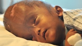 Swollen Head Baby Leaves Hospital After Successful Surgery - YouTube