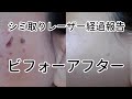 【シミ取りおすすめ】シミ取りレーザー治療の経過報告!ビフォーアフター有り/QスイッチYAGレーザー/40代女性