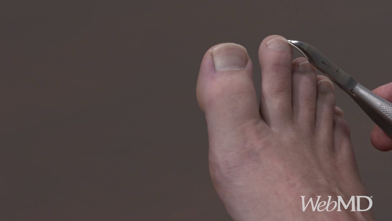 How to Trim Tough Toe Nails | WebMD