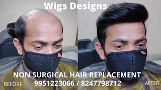 Non Surgical Hair Replacement in Bangalore | Hyderabad | 8247798712 | 9951223066