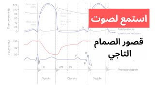 mitral regurgitation heart murmur صوت قصور الصمام التاجي | لغط القلب