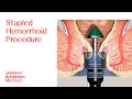 Pph procedure animation  stapled hemorrhoid surgery