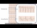 ECG in 60s - Memory T Waves