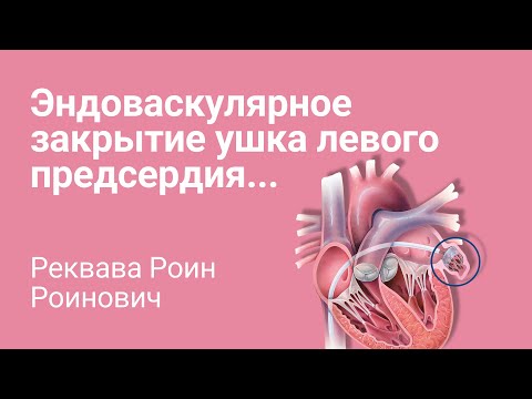 Эндоваскулярное закрытие ушка левого предсердия: секреты успешной установки...