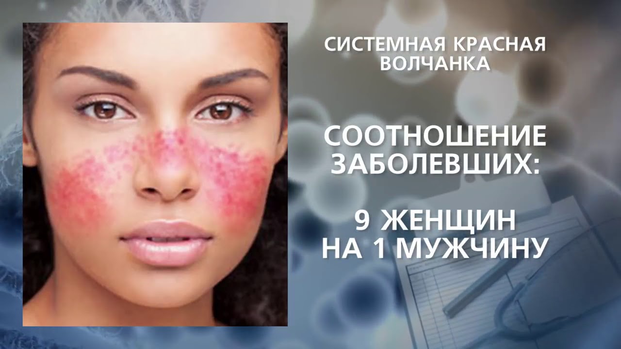 Системная красная волчанка - YouTube