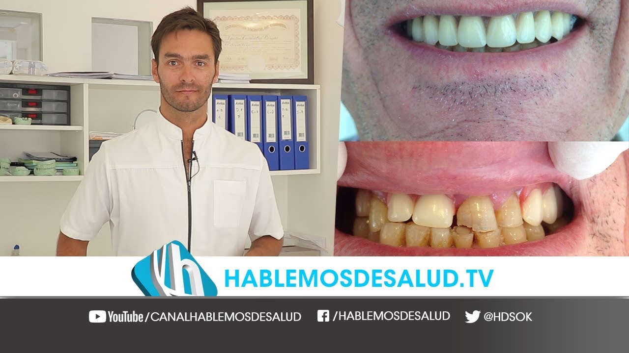 IMPLANTES DENTALES | DR. AGUSTÍN LAVANCHY BORGHI camera iphone 8 plus apk