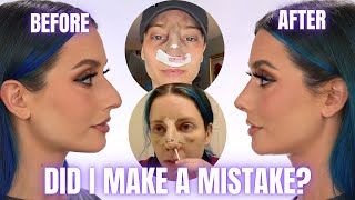 CLOSED RHINOPLASTY NOSE JOB VLOG | SURGERY DAY, DAY BY DAY RECOVERY & CAST REMOVAL REVEAL CLOSED RHINOPLASTY NOSE JOB VLOG | SURGERY DAY, DAY BY DAY RECOVERY & CAST REMOVAL REVEAL